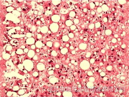 肝細胞水腫