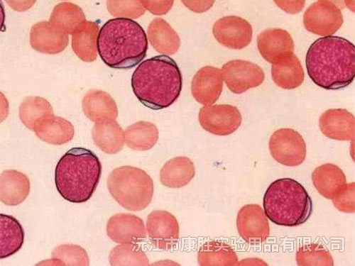 急性髓細胞白血病未成熟型（M1)